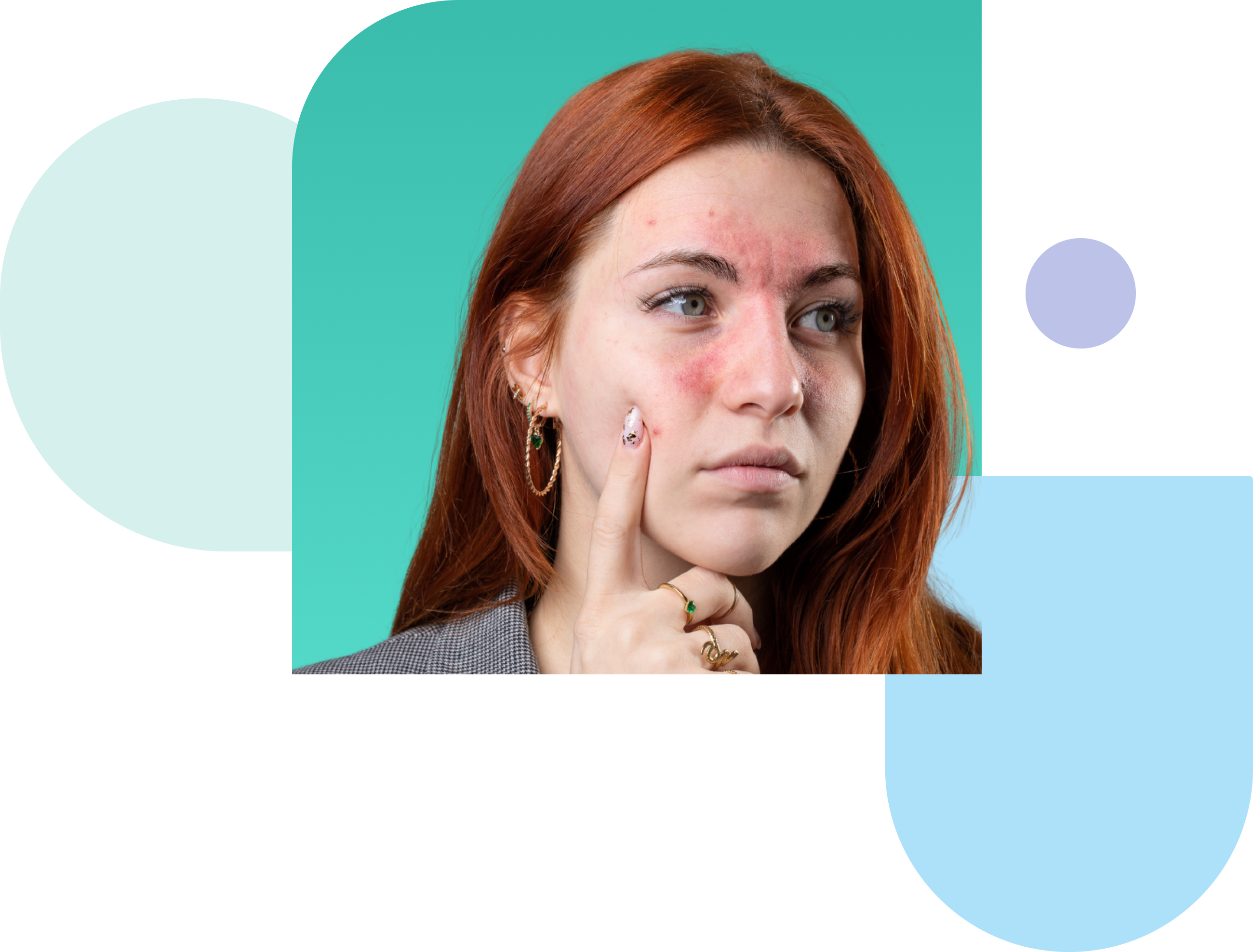 rosacea explained