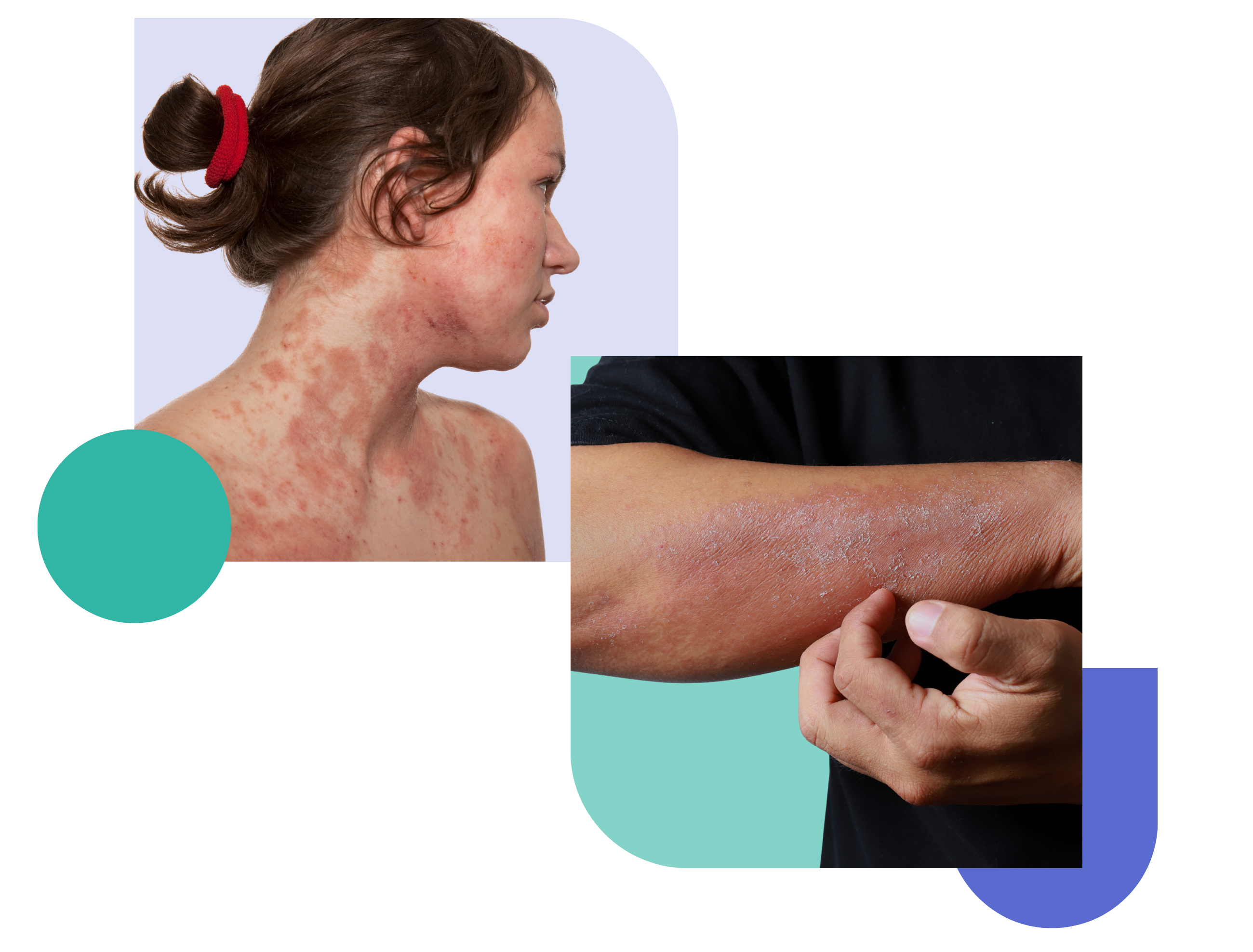 eczema treatment via online consultations image showing different part of body affected with eczema