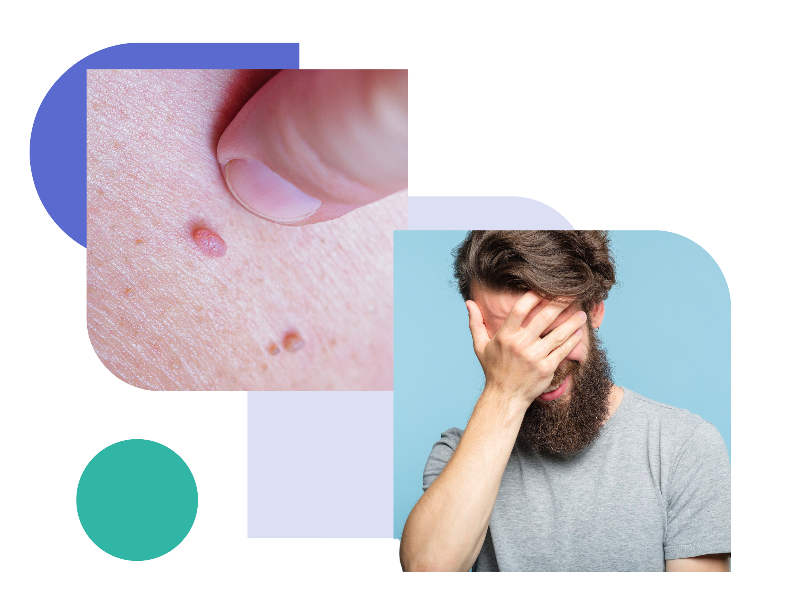 Close-up of genital warts on skin and a man covering his face with his hand, representing the physical symptoms and emotional impact of genital warts.