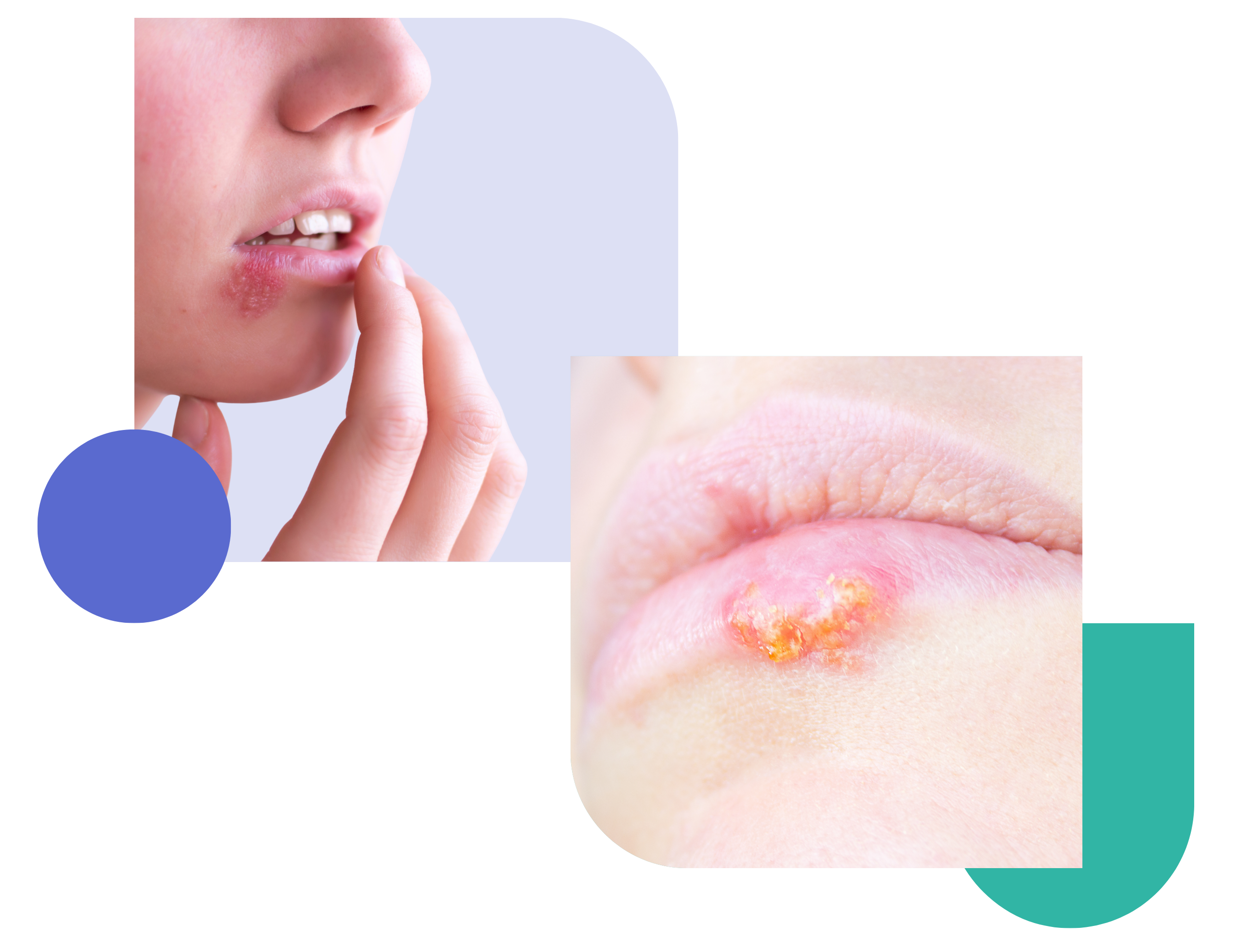 Close-up of cold sore on lip, a person is touching herpes simplex virus outbreak (HSV-1) with inflamed and crusted blisters