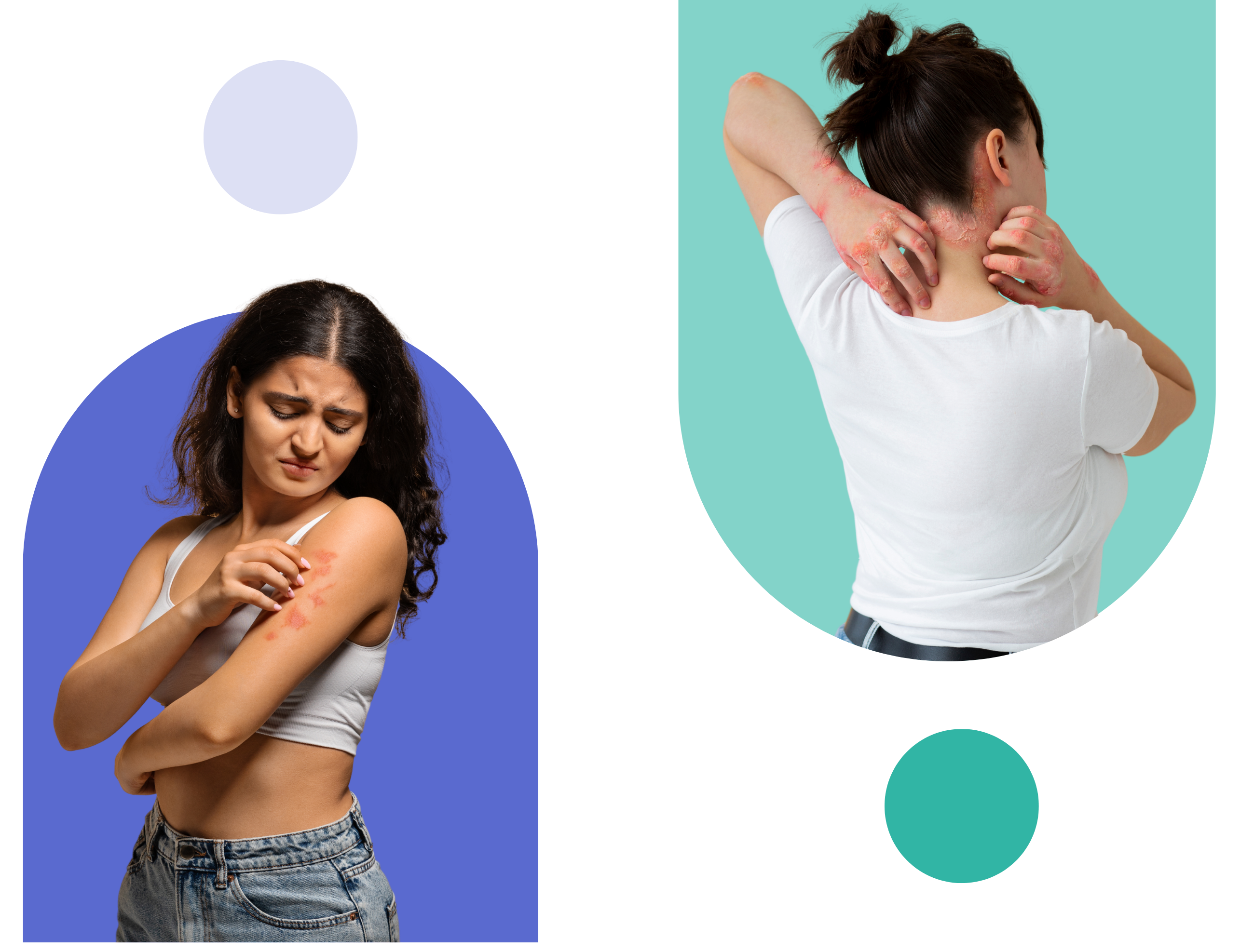 what is eczema image showing two girls with eczema problem