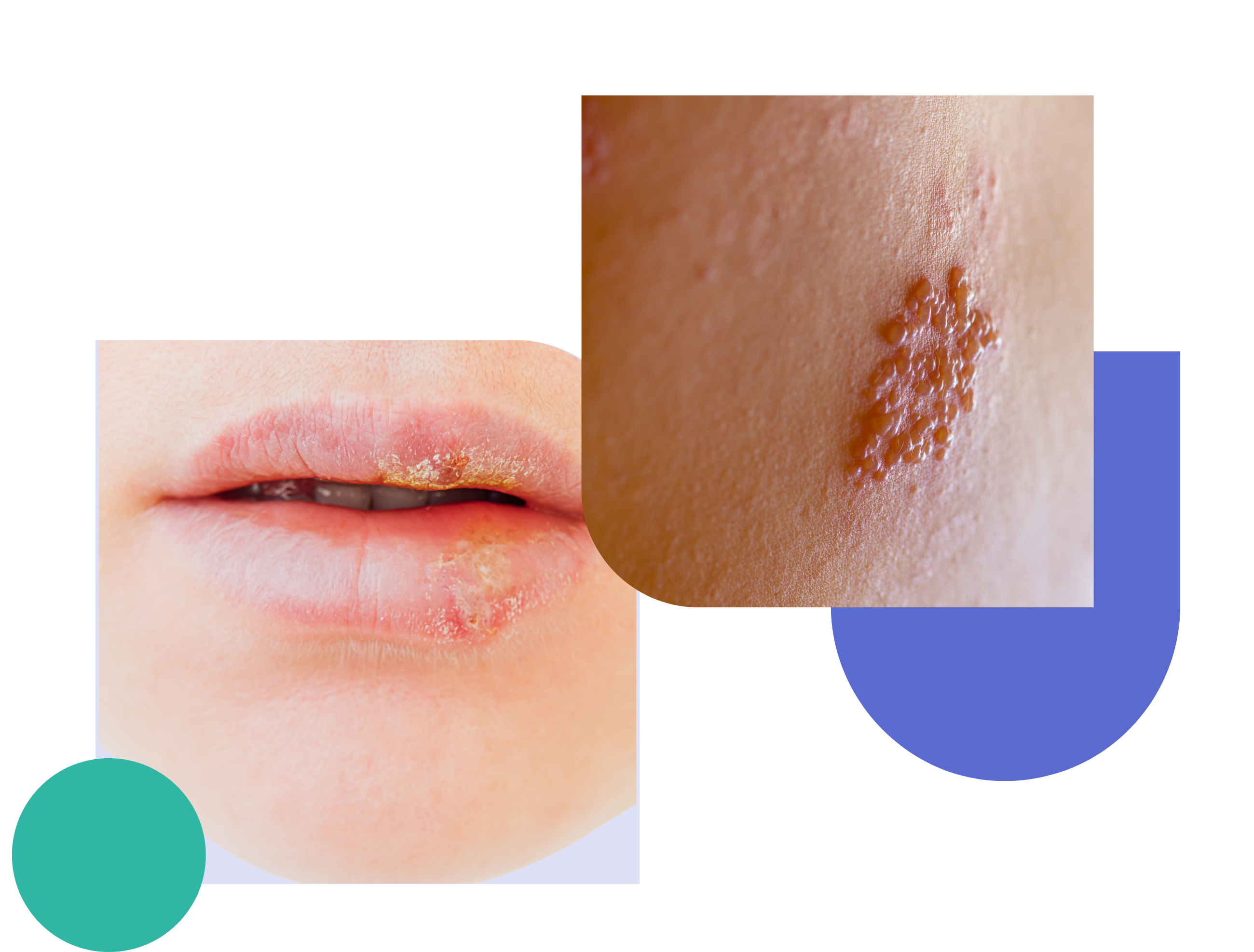 Cold sore on the lip and genital herpes skin outbreak – close-up images showing common symptoms of herpes simplex virus