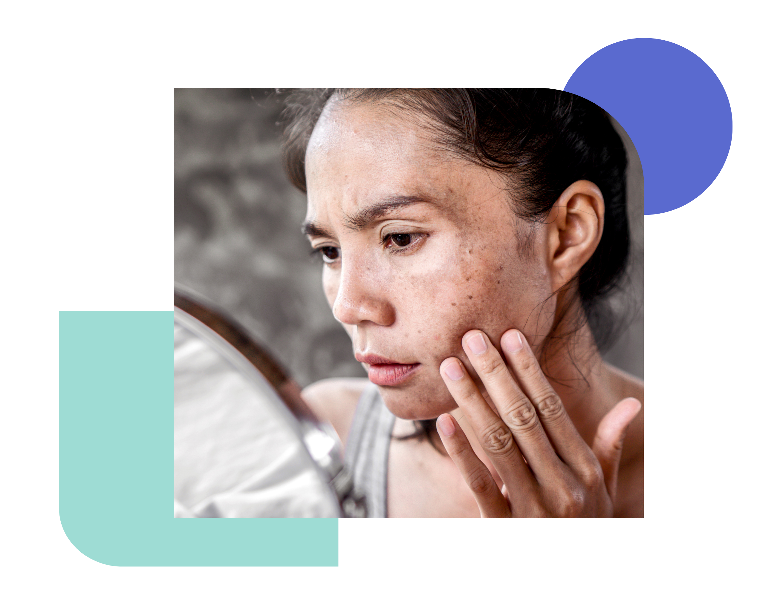 what is hydroquinone - miiskin what is hydroquinone 4 cream used for