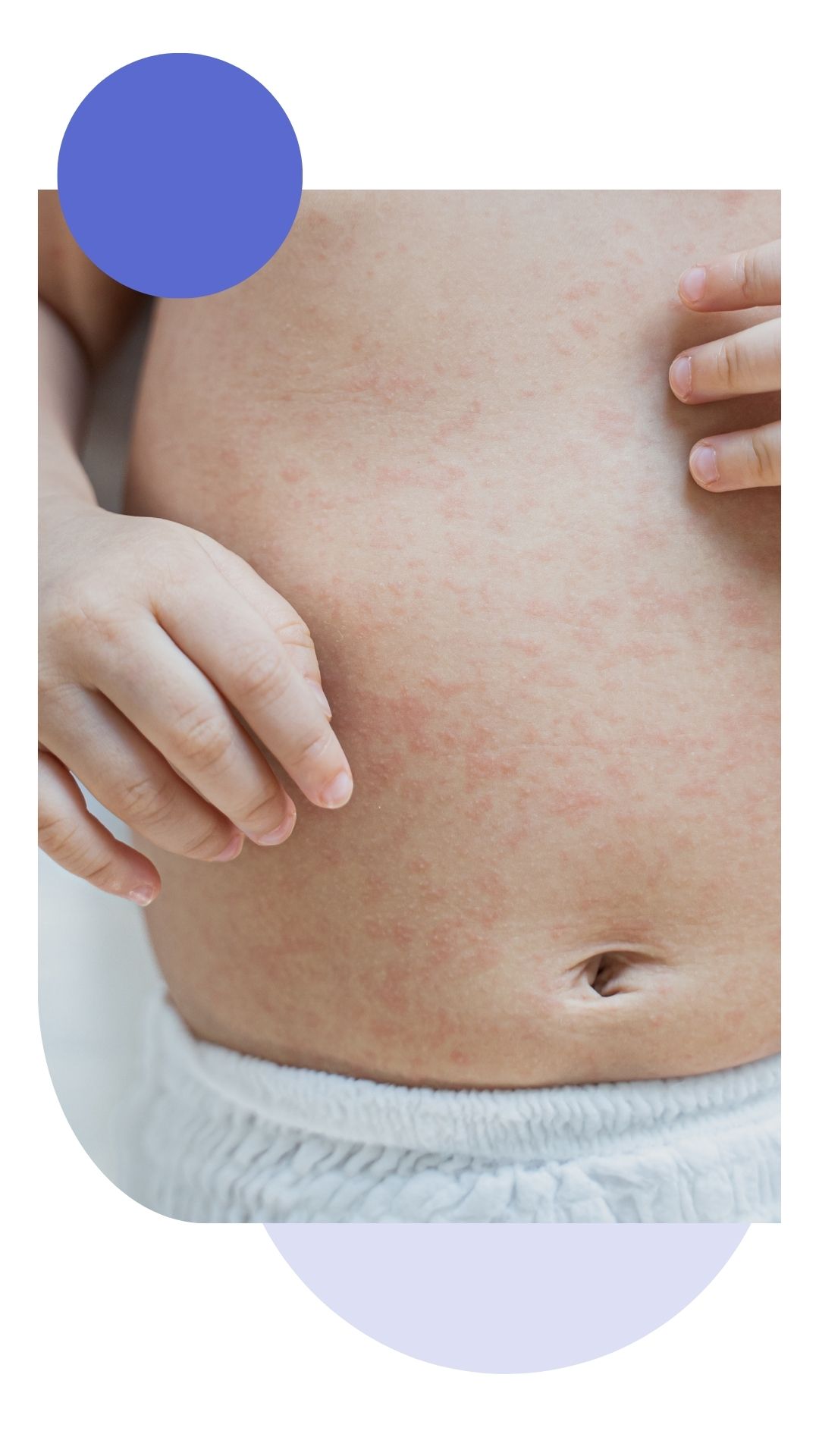 typical baby skin problems Close-up of a baby’s abdomen showing red, patchy rash and irritation on the skin. The image illustrates common infant skin conditions such as eczema or heat rash.