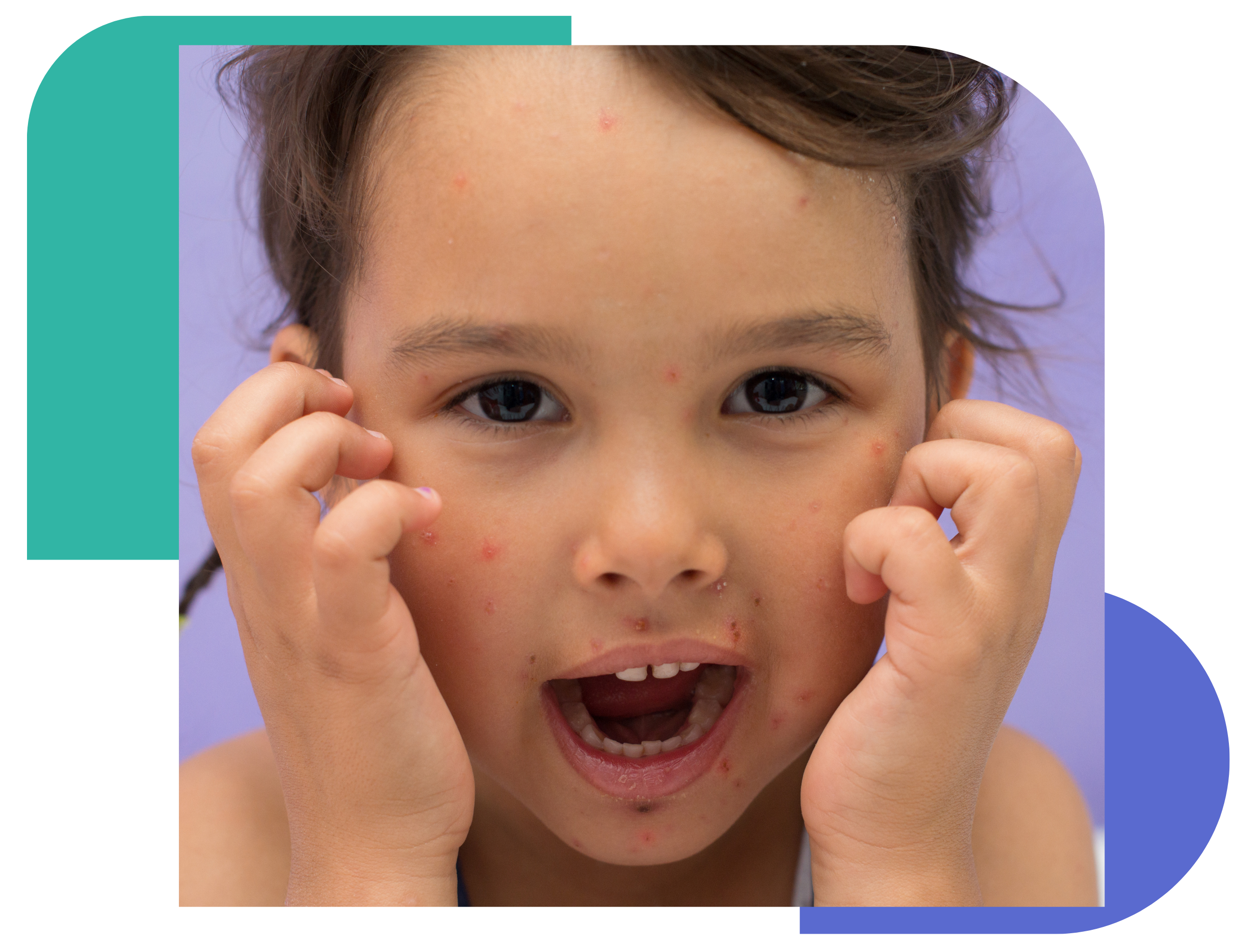 consult an online pediatric dermatologist A young child with visible red spots and rashes on their face, scratching their cheeks. The image illustrates common pediatric skin conditions that may require dermatology care.