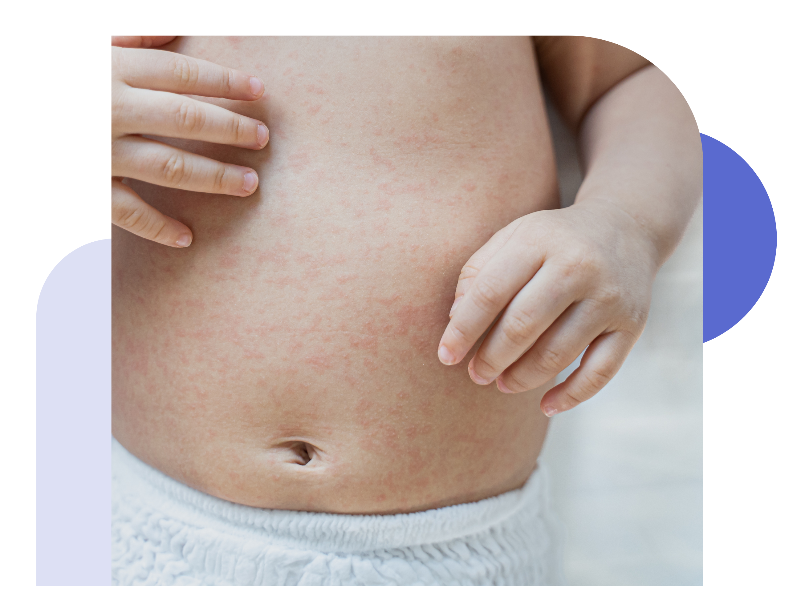 pediatric online dermatologist
