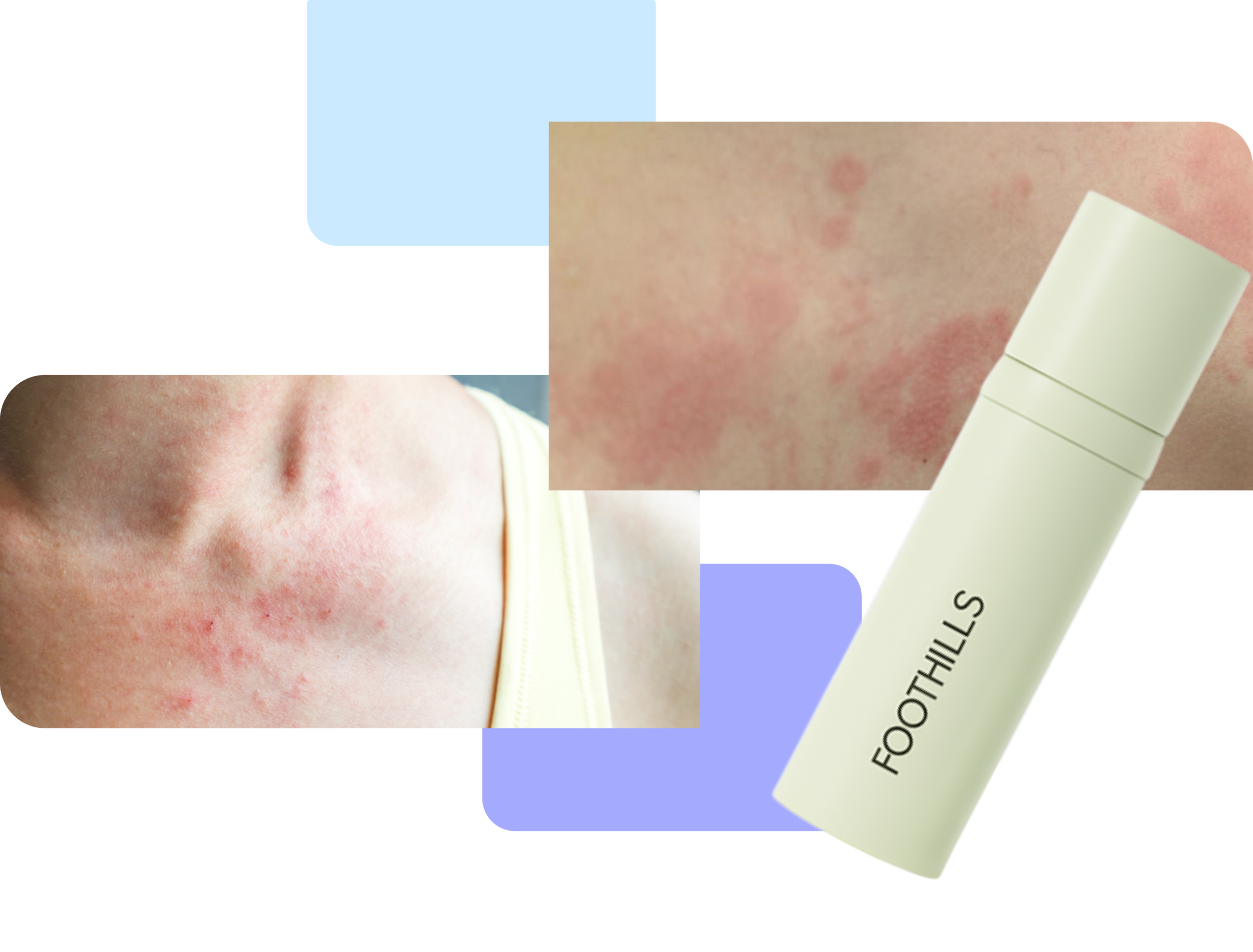 customized atopic dermatitis treatment backed by science