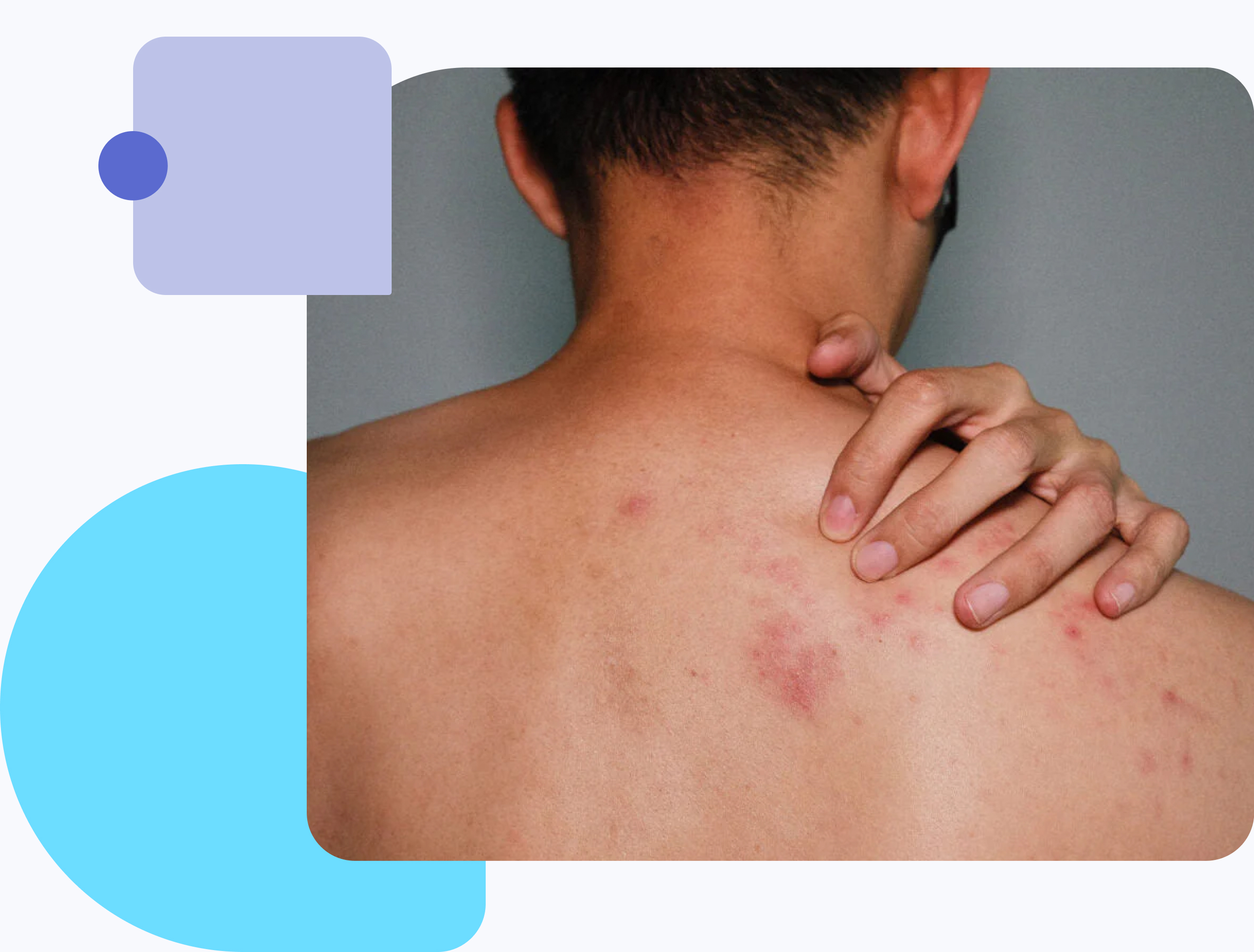 man with shingles on his back