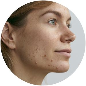 hormonal acne treatment treatment for hormonal acne