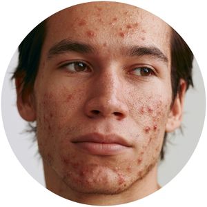 severe acne treatment treatment for severe acne