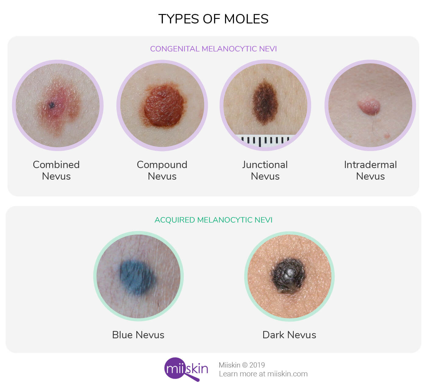moles and birthmarks types
