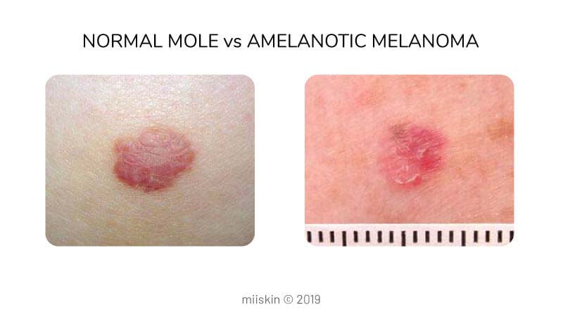 nodular melanoma flesh colored