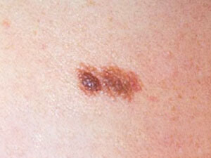 atypical dysplastic nevus flat surface