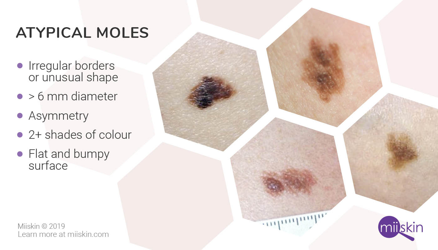 moles that change color