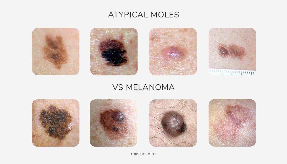 atypical dysplastic nevus vs melanoma skin cancer images