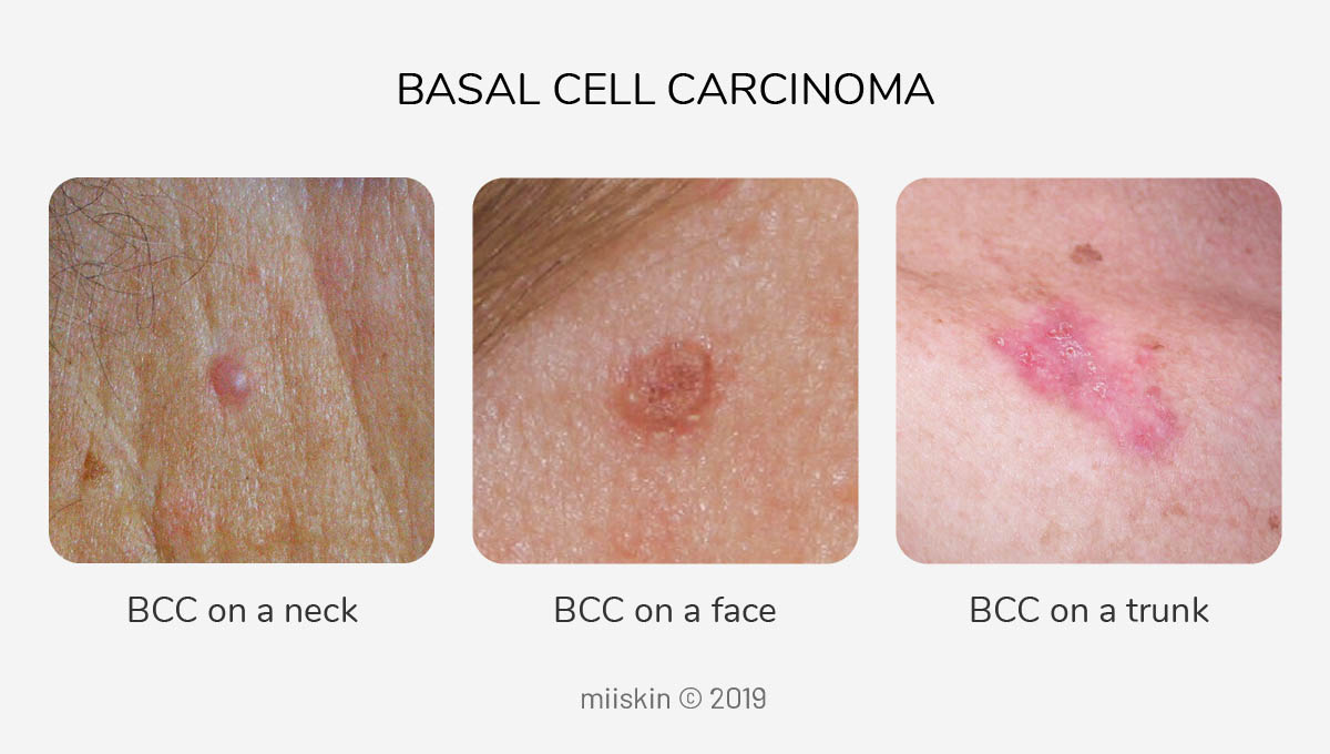 basal cell carcinoma on back