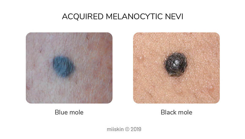 black dark blue moles - types of acquired melanocytic nevi