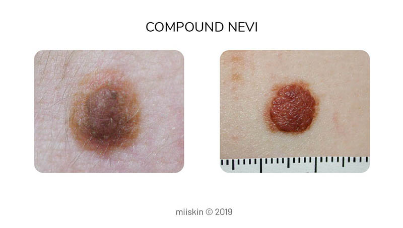 compound nevus type of congenital melanocytic mole