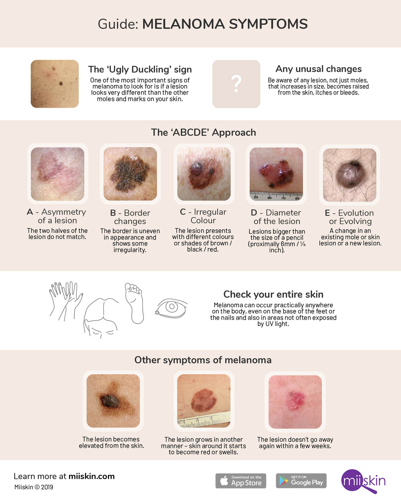 Melanoma Skin Cancer Diagram