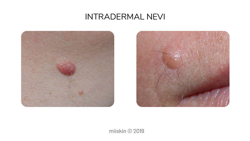 dermal nevus