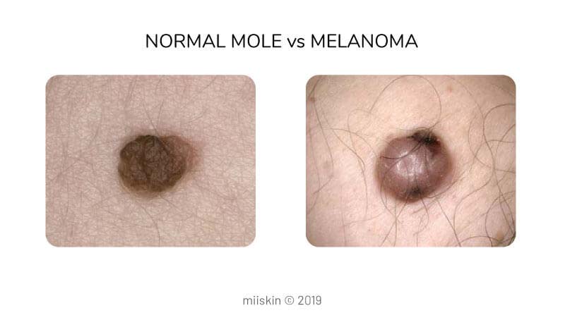 difference between mole and melanoma picture