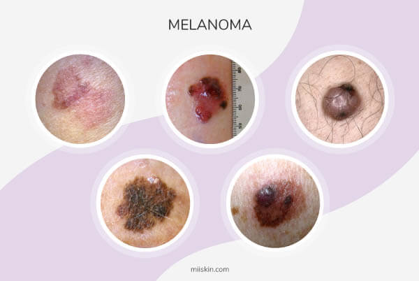 melanoma images images of melanoma
