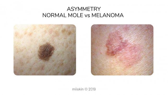 mole vs melanoma różnice w asymetrii