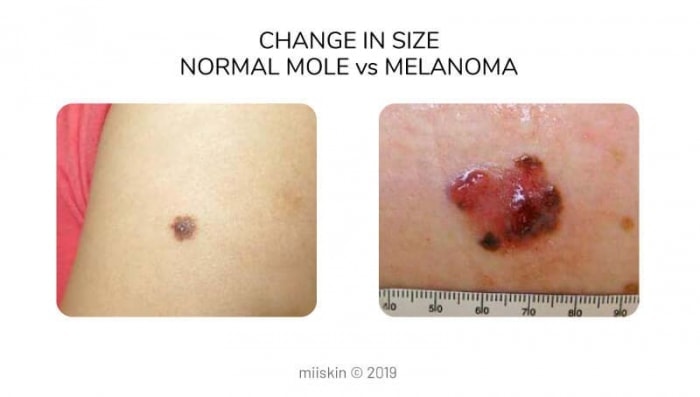 mole vs melanoma różnice w wielkości