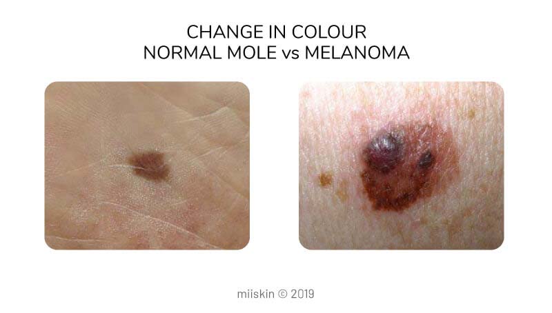 mole vs melanoma differences in colour