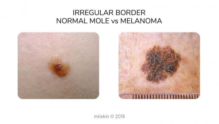mole vs melanoma differences in border