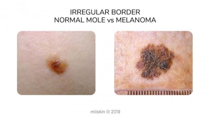 diferencias de mole vs melanoma en el borde