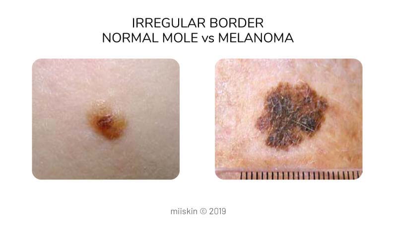 Melanoma Pictures | Skin Melanomas Vs. Non-Cancerous Moles