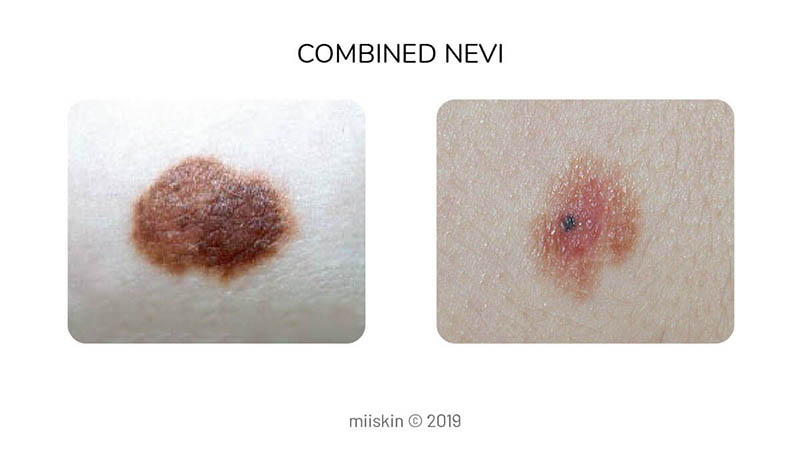 combined nevus - type of congenital melanocytic mole