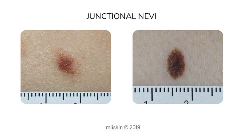 type of congenital melanocytic mole - junctional nevus