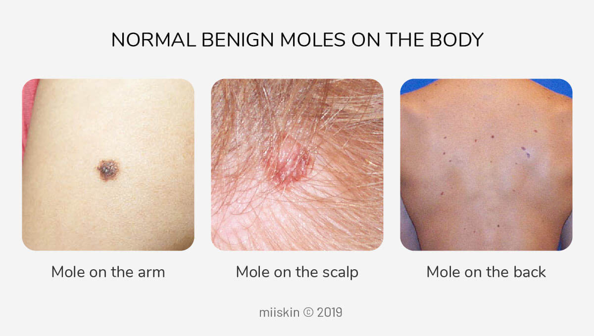 Types Of Moles On The Body