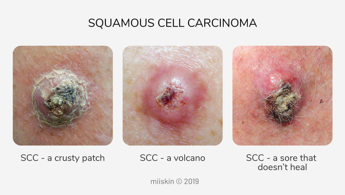 Cancerous Scalp Lesions