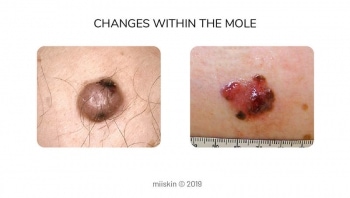 About Moles - Types, Warning Signs, Causes, and Prevention